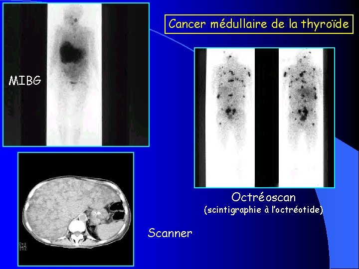 Cancer médullaire de la thyroïde MIBG Octréoscan (scintigraphie à l’octréotide) Scanner 