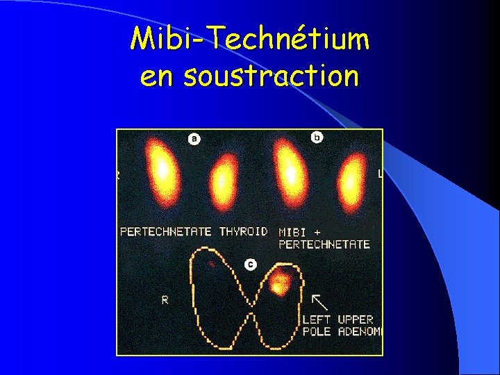 Mibi-Technétium en soustraction 
