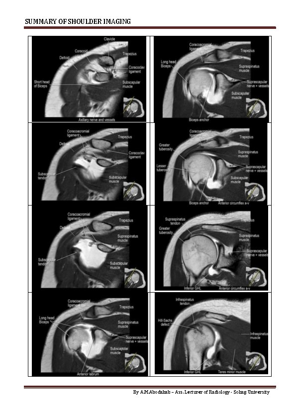 SUMMARY OF SHOULDER IMAGING By A. M. Abodahab – Ass. Lecturer of Radiology -