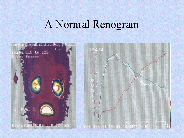 A Normal Renogram www. assignmentpoint. com 