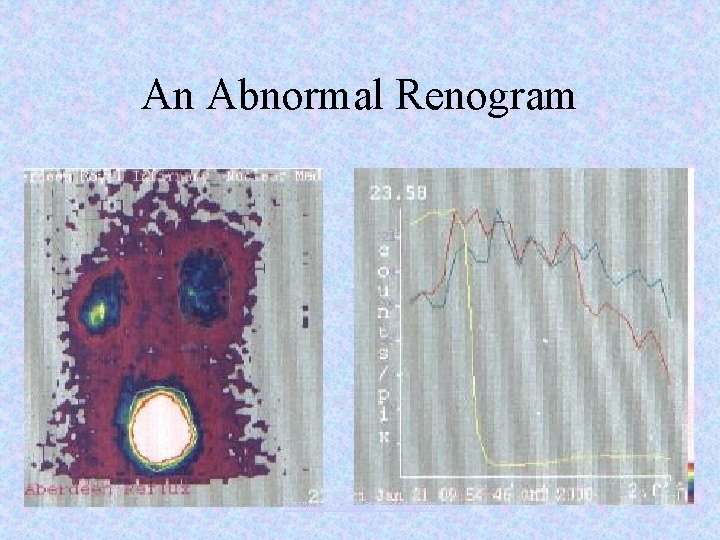 An Abnormal Renogram www. assignmentpoint. com 