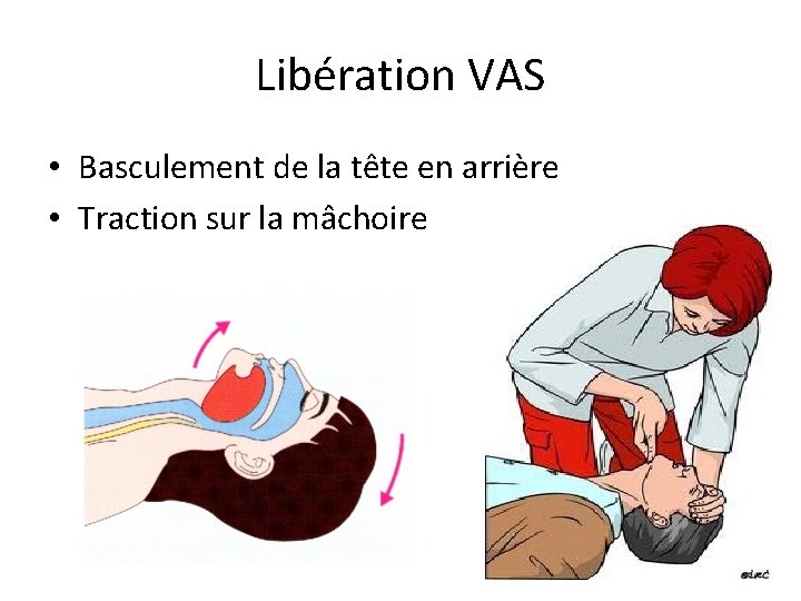 Libération VAS • Basculement de la tête en arrière • Traction sur la mâchoire