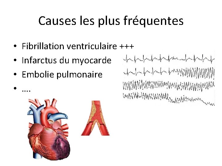 Causes les plus fréquentes • • Fibrillation ventriculaire +++ Infarctus du myocarde Embolie pulmonaire