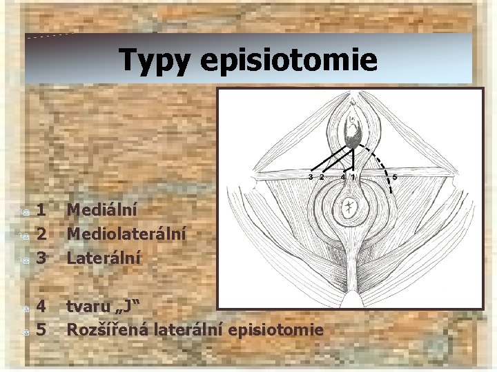 Typy episiotomie 9 9 9 1 2 3 Mediální Mediolaterální Laterální 4 5 tvaru