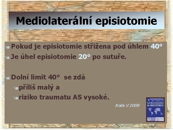 Mediolaterální episiotomie Pokud je episiotomie střižena pod úhlem 40° 9 Je úhel episiotomie 20°