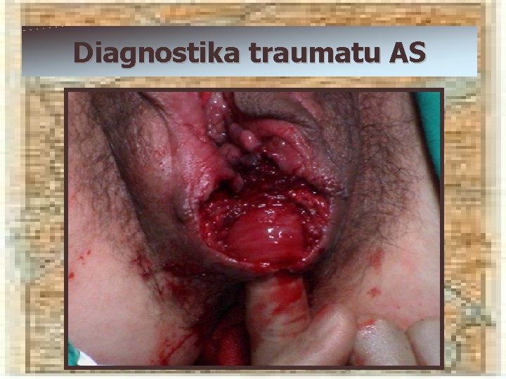 Diagnostika traumatu AS 