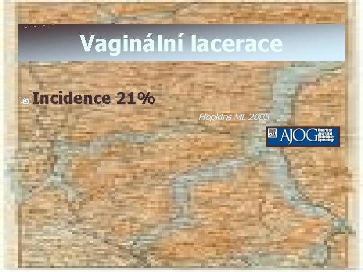 Vaginální lacerace 9 Incidence 21% Hopkins ML 2005 