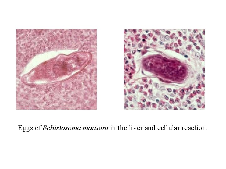 Eggs of Schistosoma mansoni in the liver and cellular reaction. 