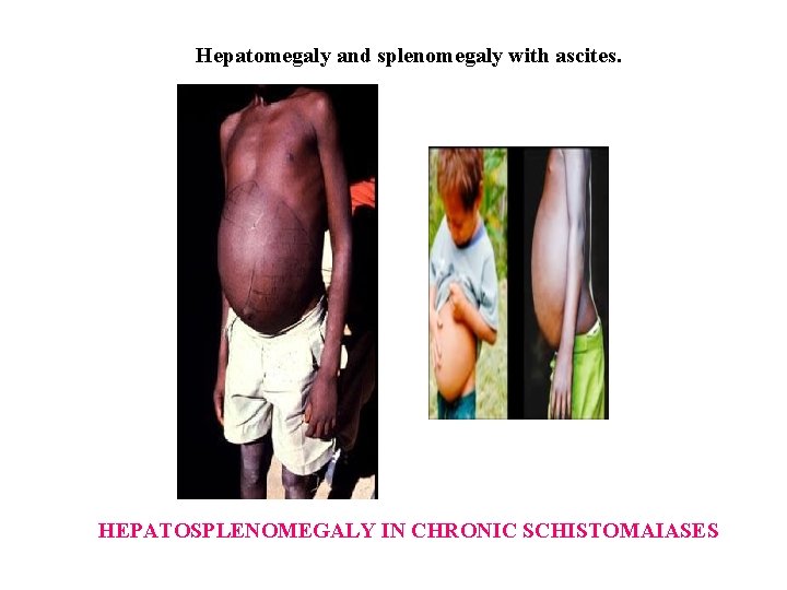 Hepatomegaly and splenomegaly with ascites. HEPATOSPLENOMEGALY IN CHRONIC SCHISTOMAIASES 