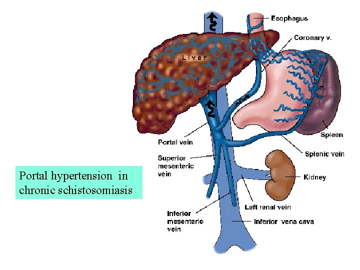 Portal hypertension in chronic schistosomiasis 