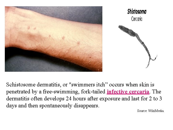 Schistosome dermatitis, or "swimmers itch” occurs when skin is penetrated by a free-swimming, fork-tailed