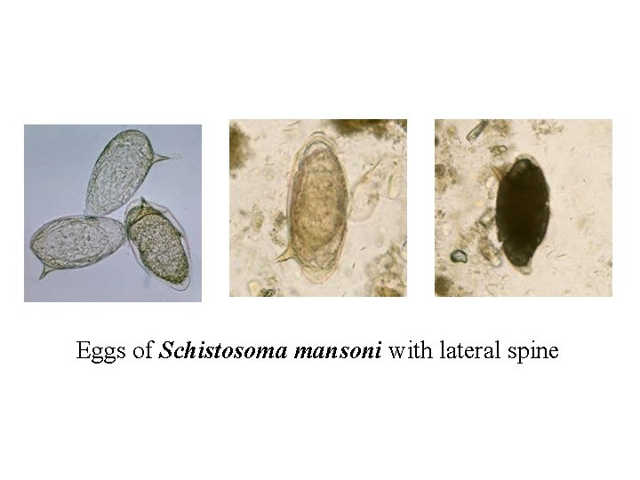 Eggs of Schistosoma mansoni with lateral spine 