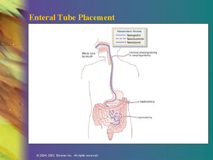 Enteral Tube Placement © 2004, 2002 Elsevier Inc. All rights reserved. 