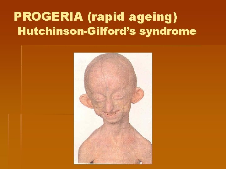 PROGERIA (rapid ageing) Hutchinson-Gilford’s syndrome 
