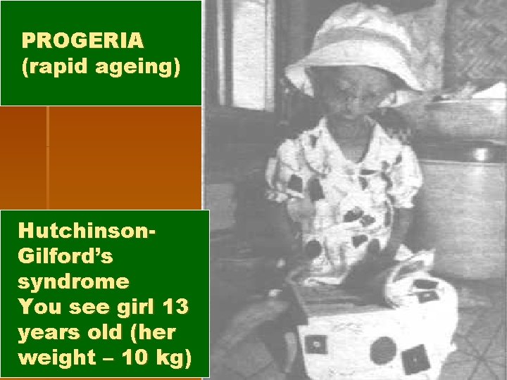 PROGERIA (rapid ageing) Hutchinson. Gilford’s syndrome You see girl 13 years old (her weight