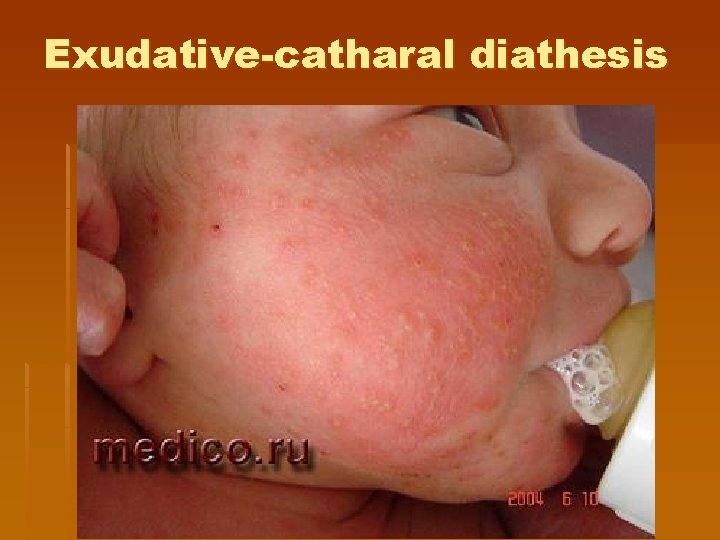 Exudative-catharal diathesis 