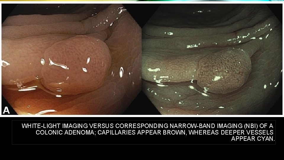 WHITE-LIGHT IMAGING VERSUS CORRESPONDING NARROW-BAND IMAGING (NBI) OF A COLONIC ADENOMA; CAPILLARIES APPEAR BROWN,