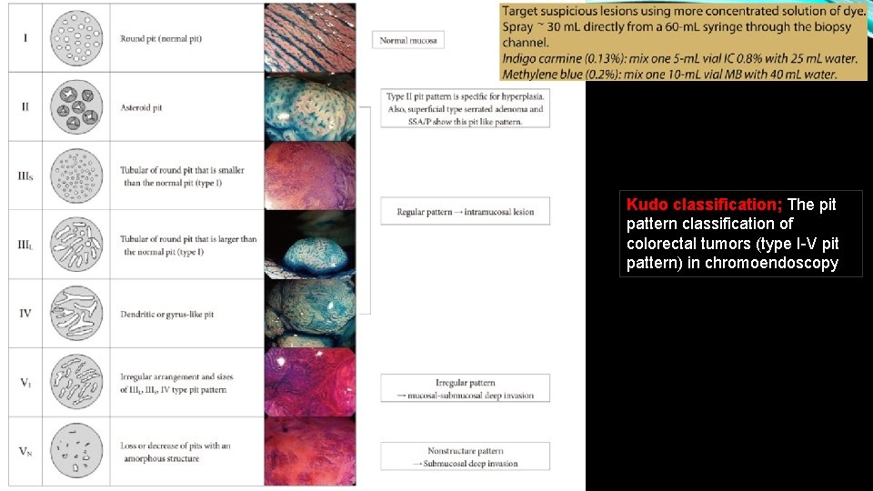 Kudo classification; The pit pattern classification of colorectal tumors (type I-V pit pattern) in