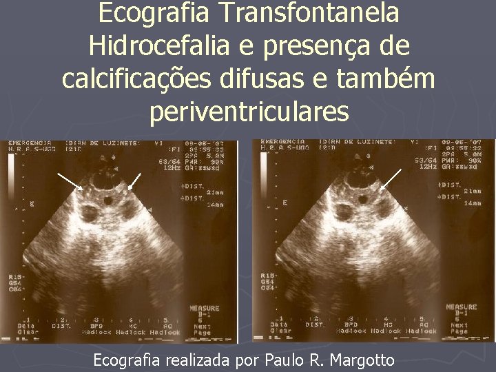 Ecografia Transfontanela Hidrocefalia e presença de calcificações difusas e também periventriculares Ecografia realizada por