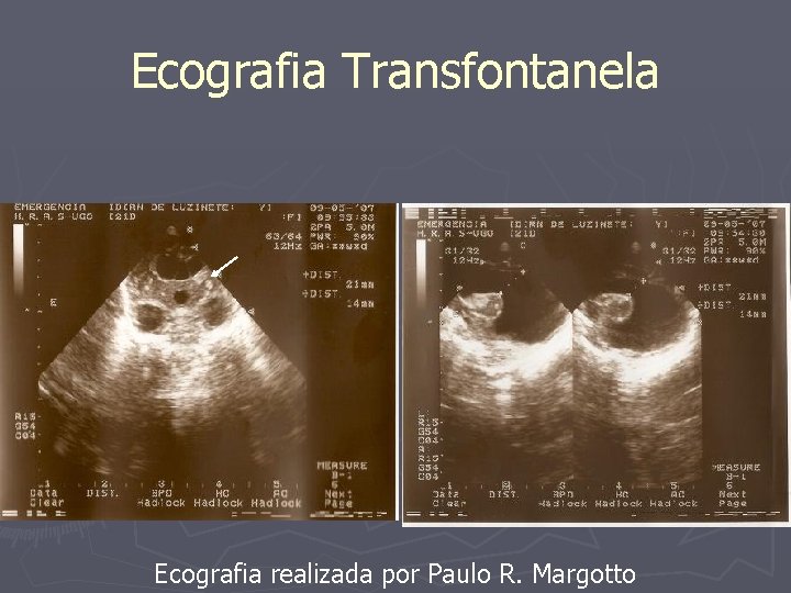 Ecografia Transfontanela Ecografia realizada por Paulo R. Margotto 