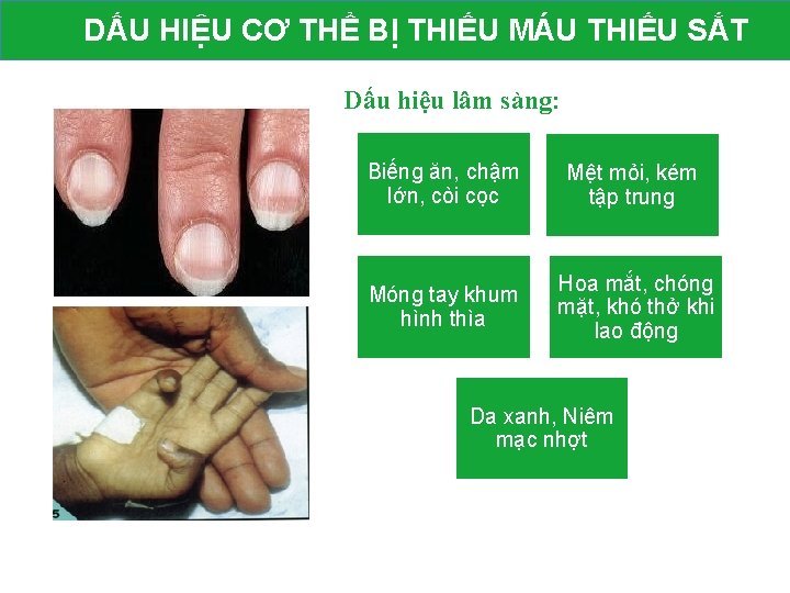 DẤU HIỆU CƠ THỂ BỊ THIẾU MÁU THIẾU SẮT Dấu hiệu lâm sàng: Biếng