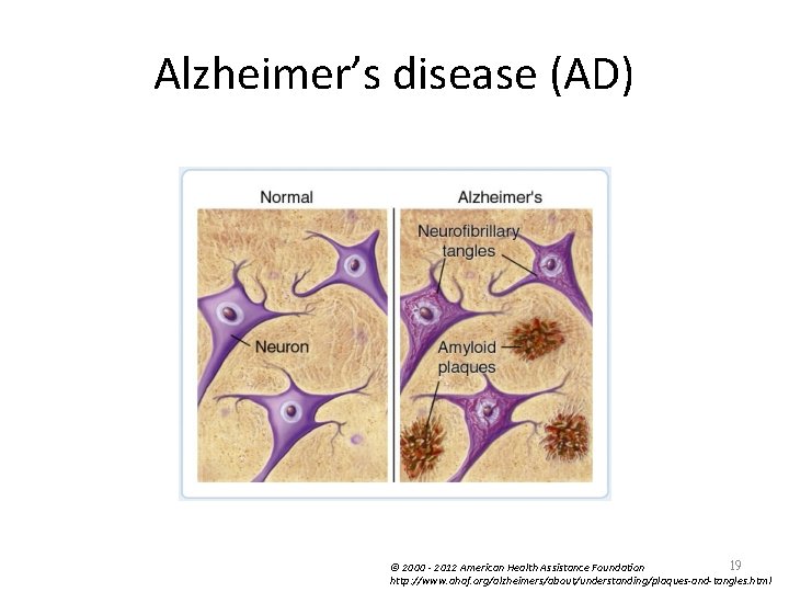 Alzheimer’s disease (AD) 19 © 2000 - 2012 American Health Assistance Foundation http: //www.