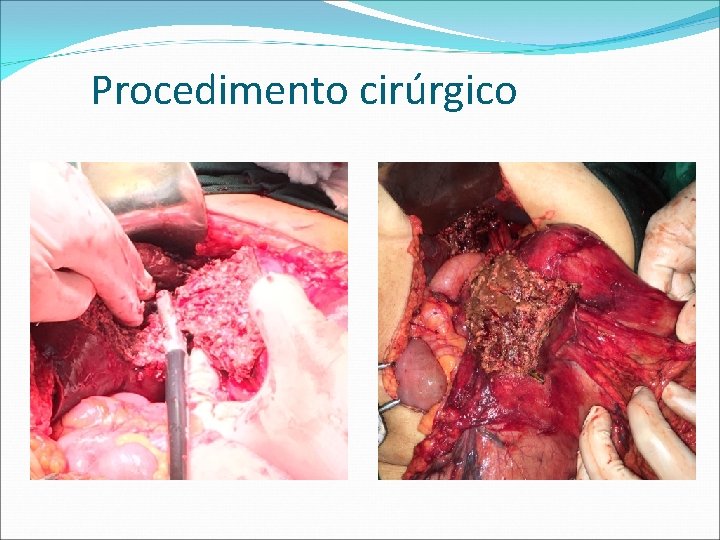 Procedimento cirúrgico 