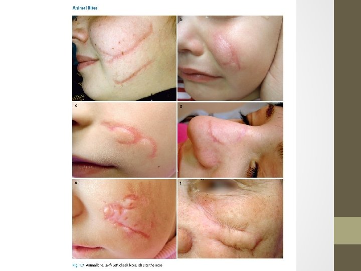 cat scratch scar removal