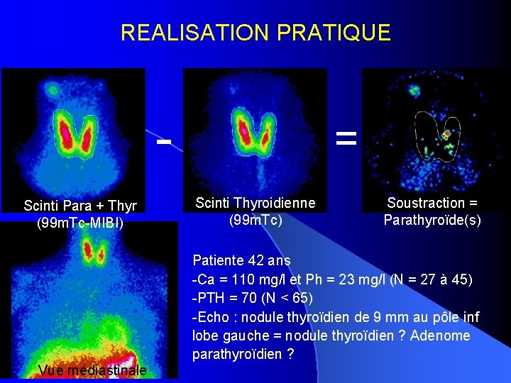 REALISATION PRATIQUE Scinti Para + Thyr (99 m. Tc-MIBI) = Scinti Thyroidienne (99 m.