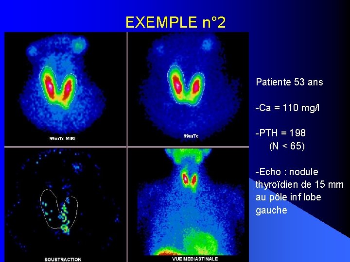 EXEMPLE n° 2 Patiente 53 ans -Ca = 110 mg/l -PTH = 198 (N