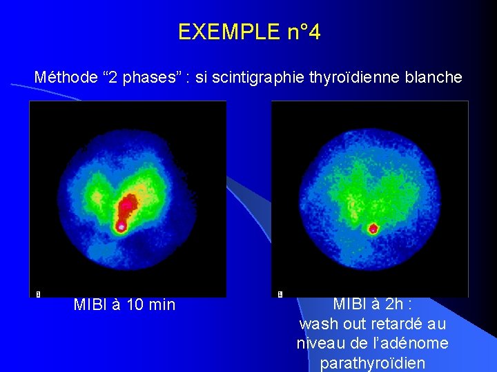EXEMPLE n° 4 Méthode “ 2 phases” : si scintigraphie thyroïdienne blanche MIBI à