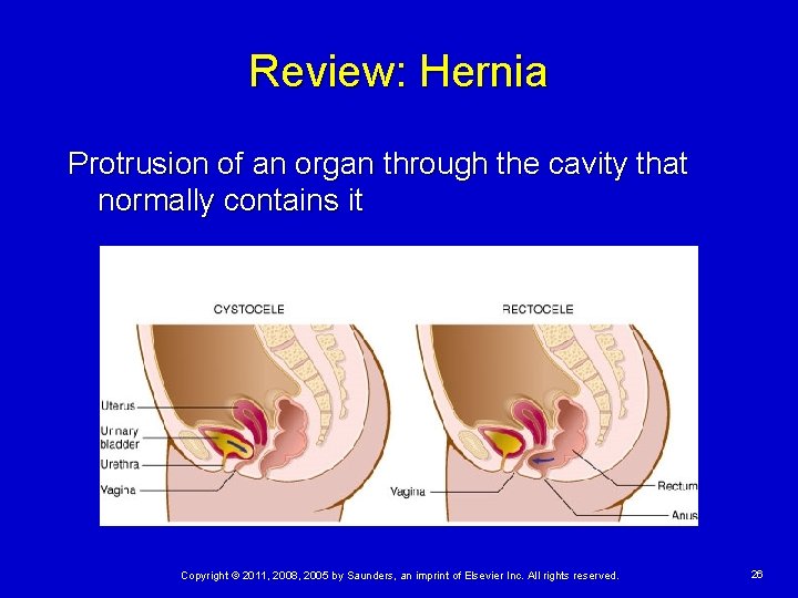 Review: Hernia Protrusion of an organ through the cavity that normally contains it Copyright