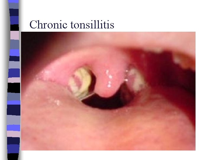 Chronic tonsillitis 