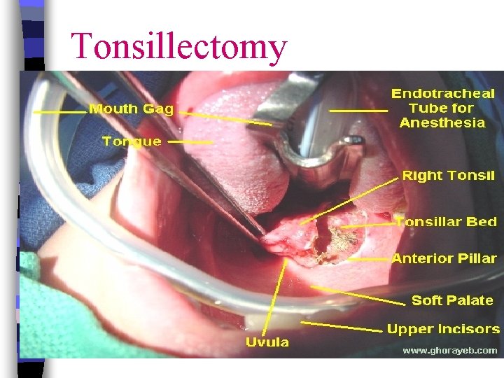 Tonsillectomy 
