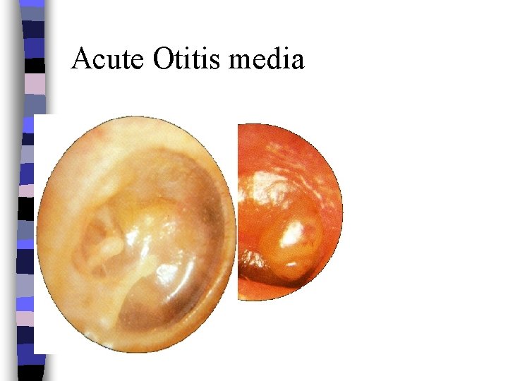 Acute Otitis media 