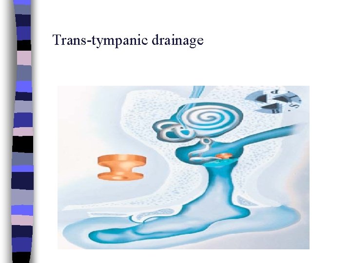 Trans-tympanic drainage 