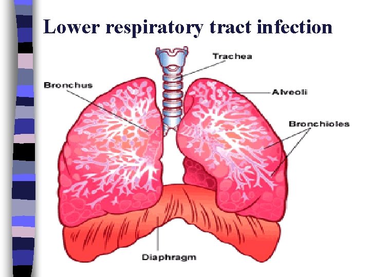 Lower respiratory tract infection 