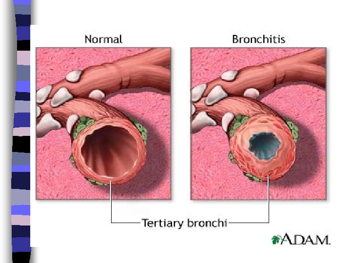 Bronchitis 