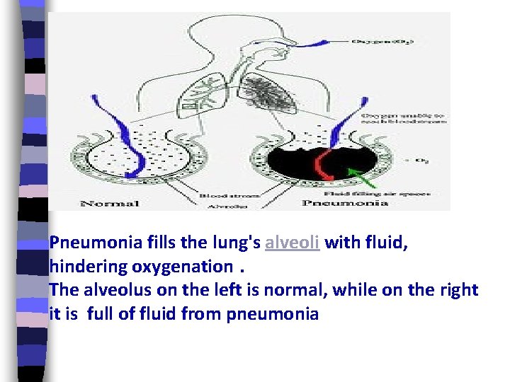 Pneumonia fills the lung's alveoli with fluid, hindering oxygenation. The alveolus on the left