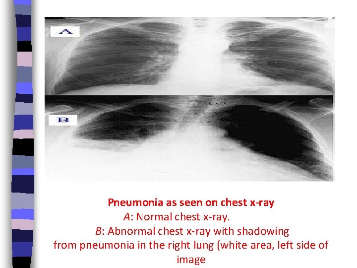 Pneumonia as seen on chest x-ray A: Normal chest x-ray. B: Abnormal chest x-ray