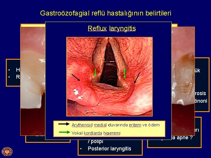 Gastroözofagial reflü hastalığının belirtileri Tipik semptomlar • • Atipik semptomlar Heartburn Regürjitasyon • •