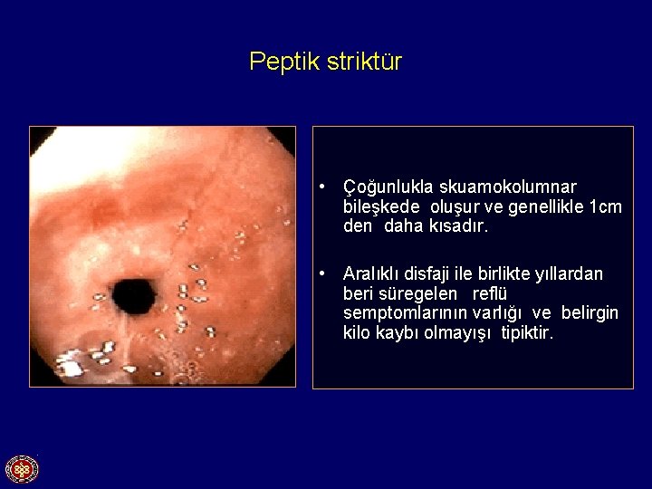 Peptik striktür • Çoğunlukla skuamokolumnar bileşkede oluşur ve genellikle 1 cm den daha kısadır.