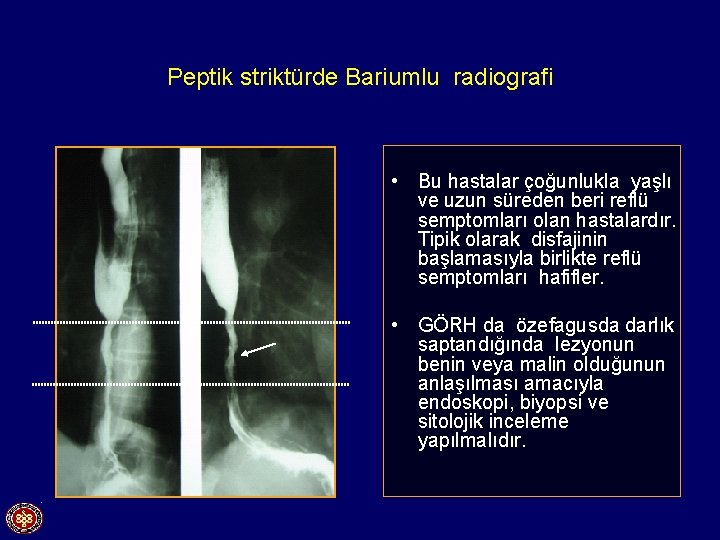 Peptik striktürde Bariumlu radiografi • Bu hastalar çoğunlukla yaşlı ve uzun süreden beri reflü