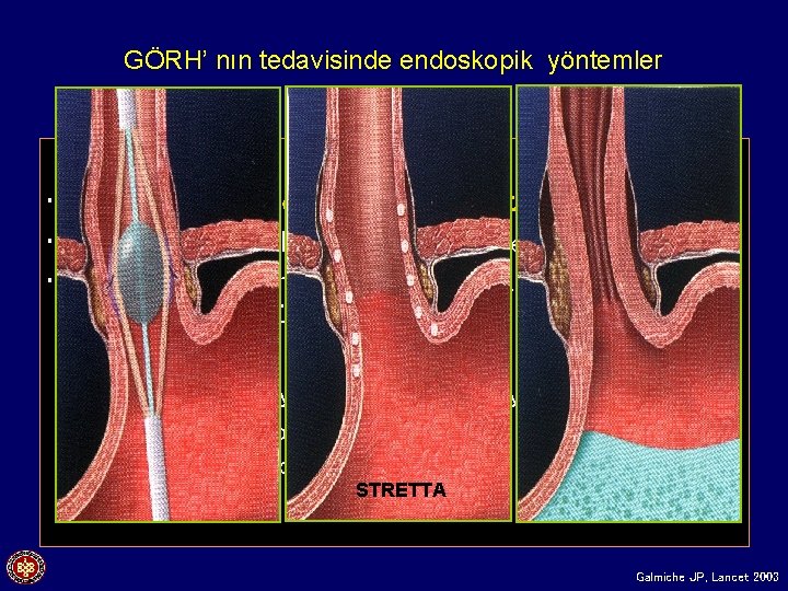 GÖRH’ nın tedavisinde endoskopik yöntemler • Radiofrekans enerji uygulaması (Stretta) • Gastrik valvüloplasti (Gastroplasty
