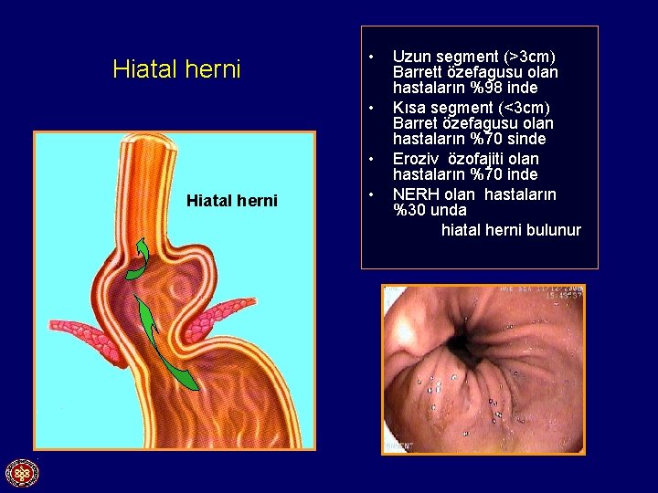 Hiatal herni • • • Hiatal herni • Uzun segment (>3 cm) Barrett özefagusu