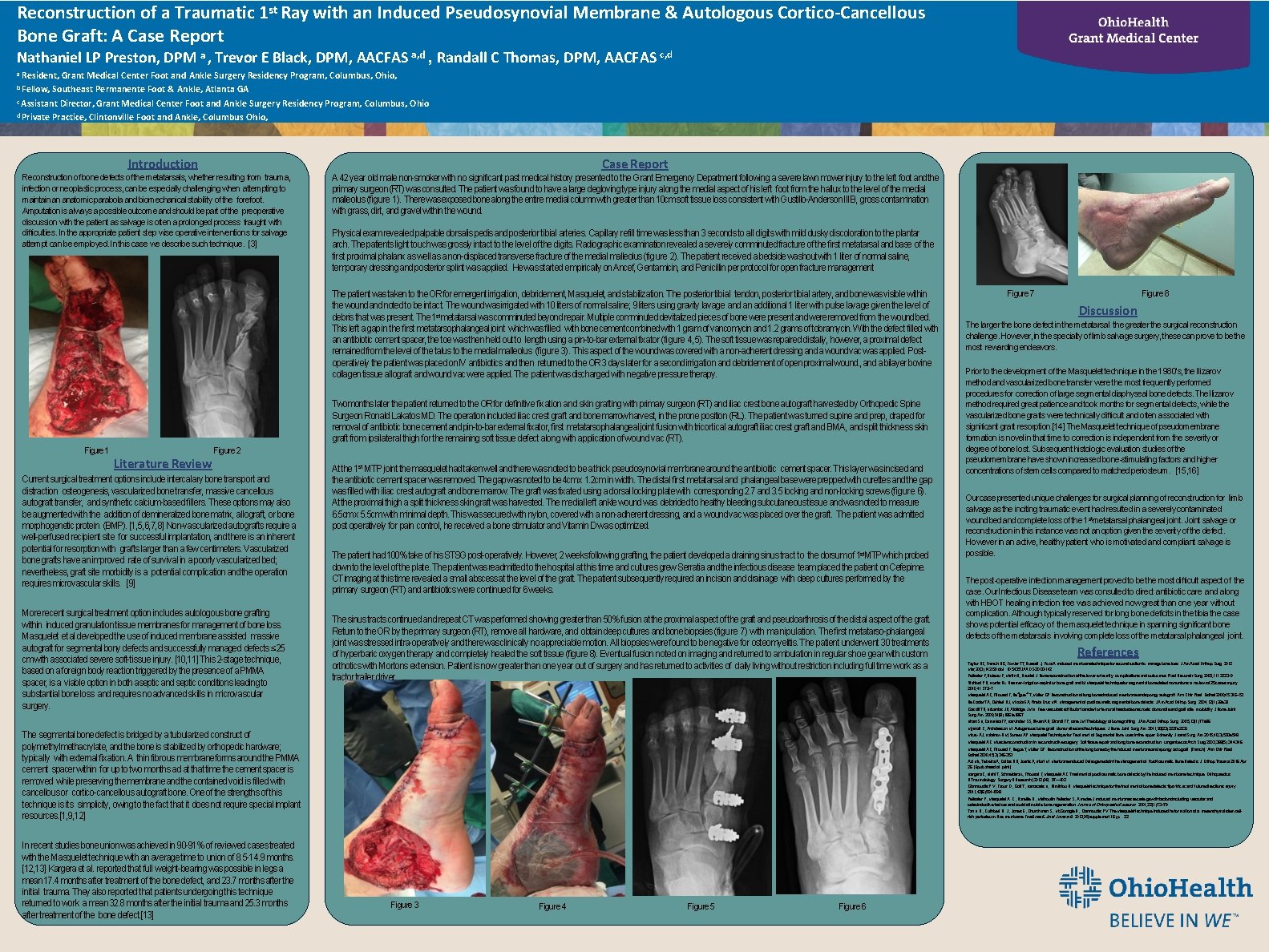 Reconstruction of a Traumatic 1 st Ray with an Induced Pseudosynovial Membrane & Autologous