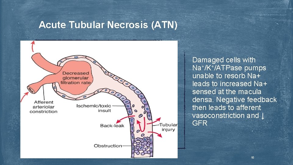 Acute Tubular Necrosis (ATN) Damaged cells with Na+/K+/ATPase pumps unable to resorb Na+ leads