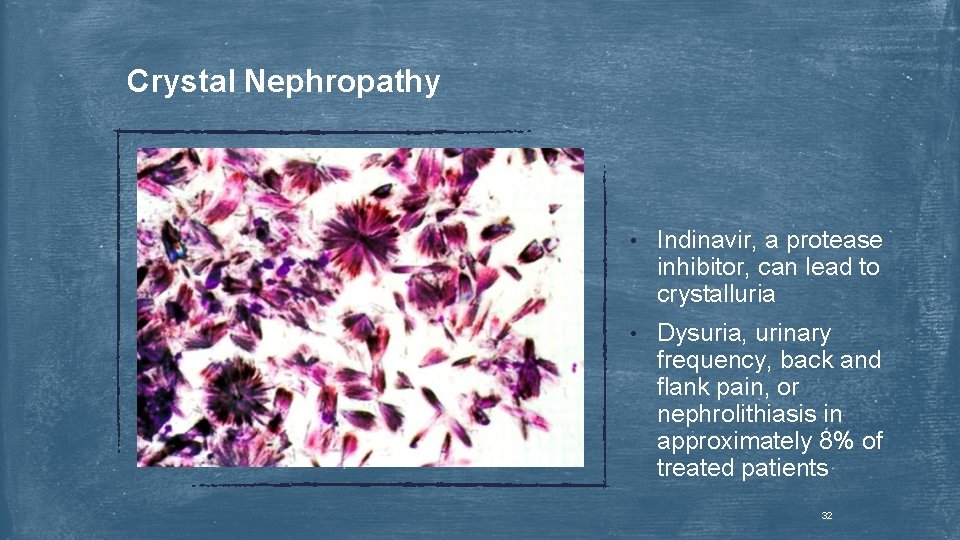 Crystal Nephropathy • Indinavir, a protease inhibitor, can lead to crystalluria • Dysuria, urinary