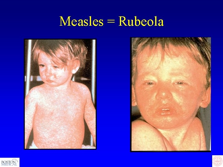 Measles = Rubeola 