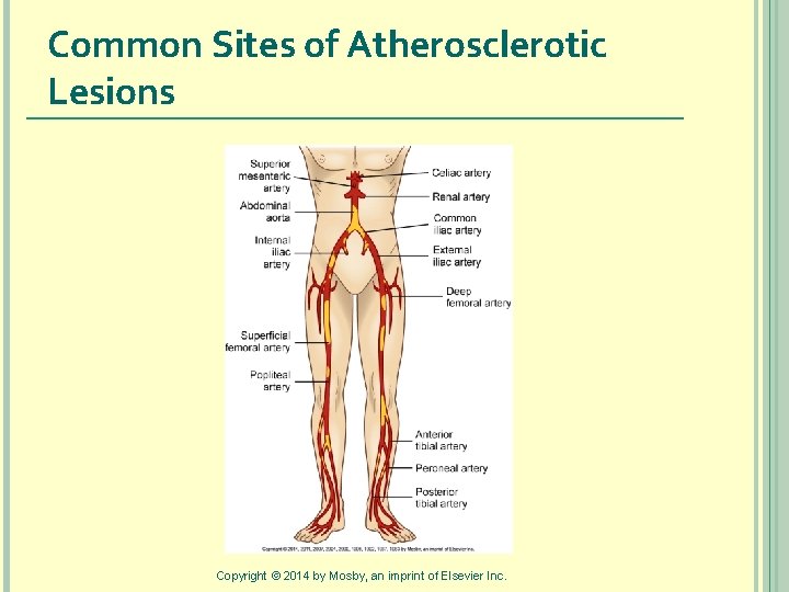 Common Sites of Atherosclerotic Lesions Copyright © 2014 by Mosby, an imprint of Elsevier